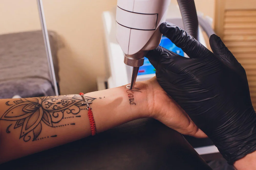 Laserbehandlung eines Tattoos am Unterarm